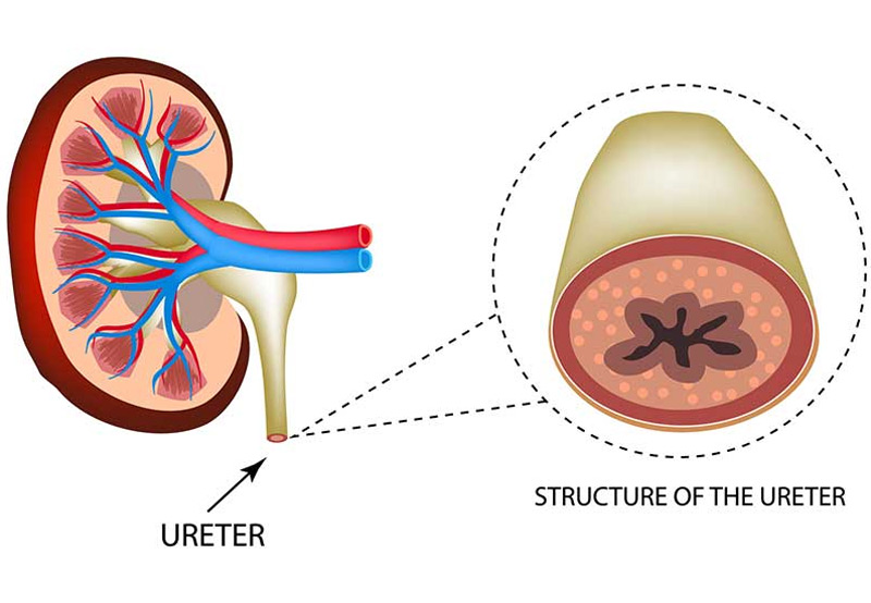 Ureteral-Duplication