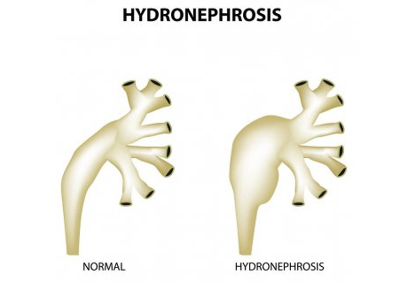 medical-concept-of-hydronephrosis-Dr.-Elias-Wehbi