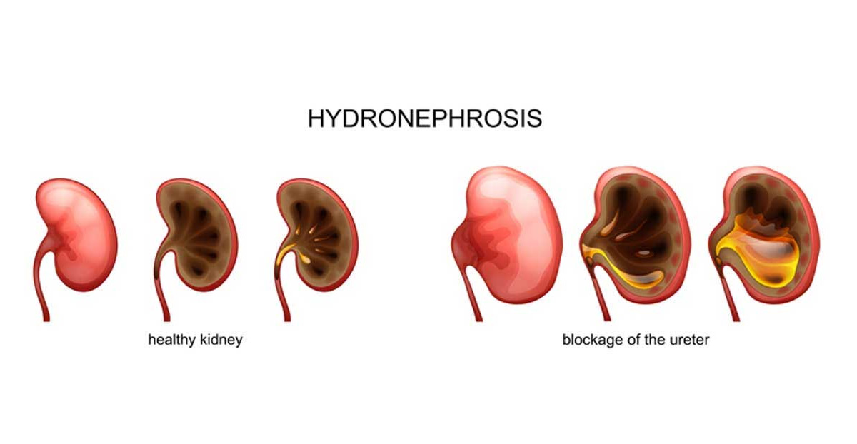 medical-concept-of-hydronephrosis-Dr.-Elias-Wehbi