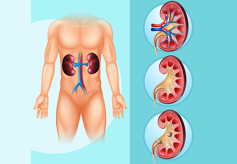 medical-concept-of-kidney-stones-Dr.-Elias-Wehbi