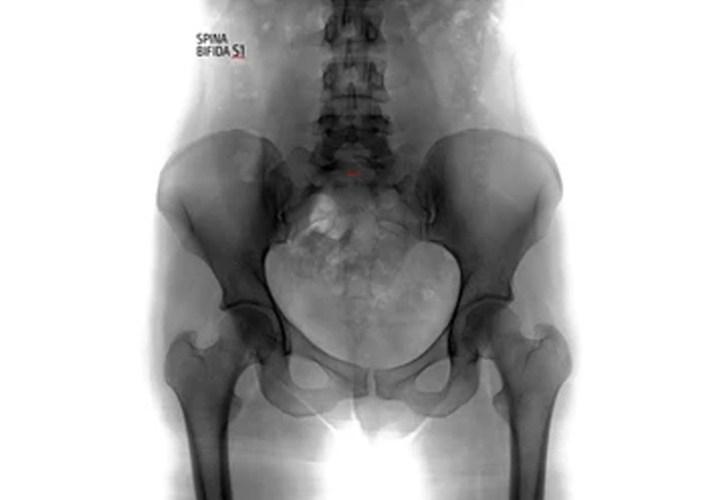 spina-bifida-requiring-urologic-care-Dr.-Elias-Wehbi