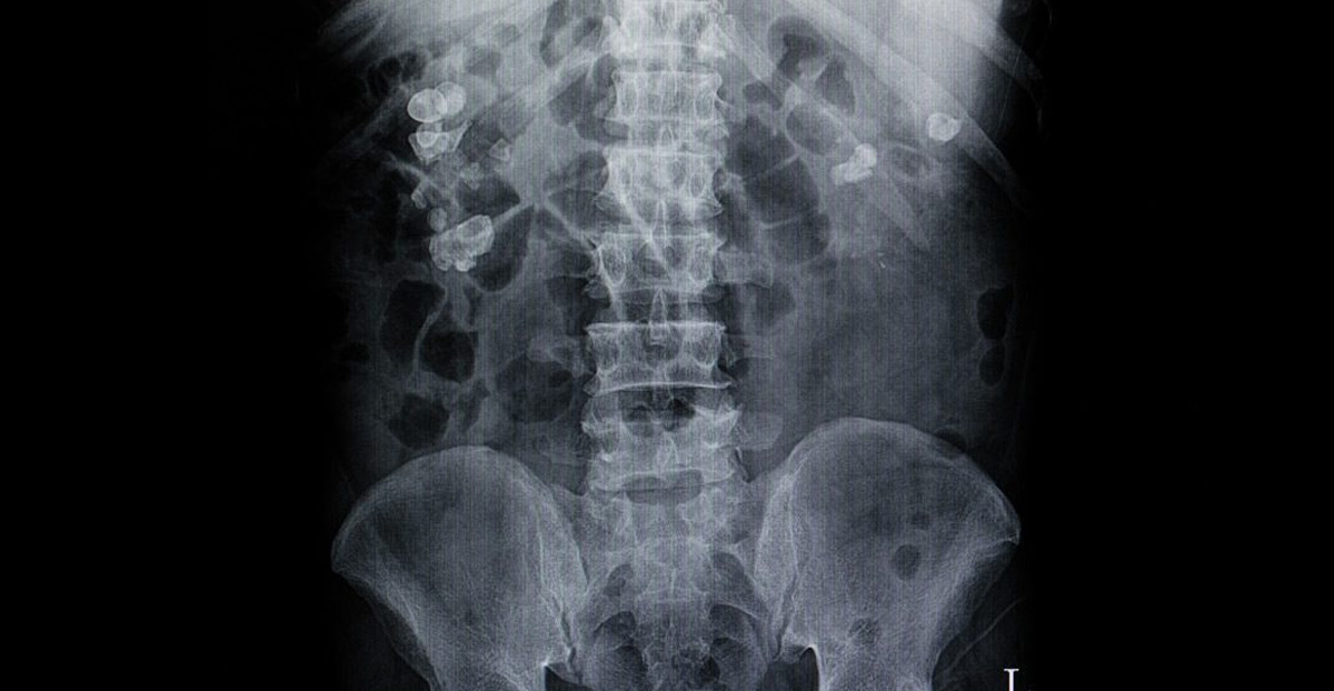 x-ray-of-kidney-stones-Dr.-Elias-Wehbi