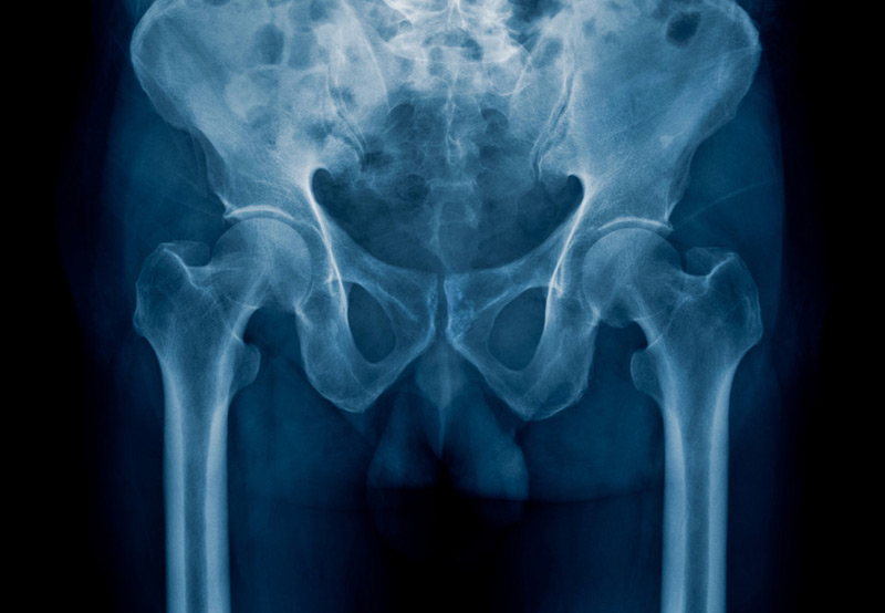 x-ray-of-pelvic-pain-related-to-genitourinary-trauma-Dr.-Elias-Wehbi
