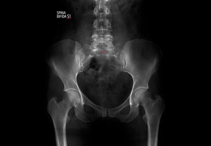 x-ray-showing-spina-bifida-Dr.-Elias-Wehbi